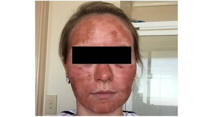 A woman's face the day after she received laser resurfacing treatment from the Lumps & Bumps clinic. Photo: Supplied